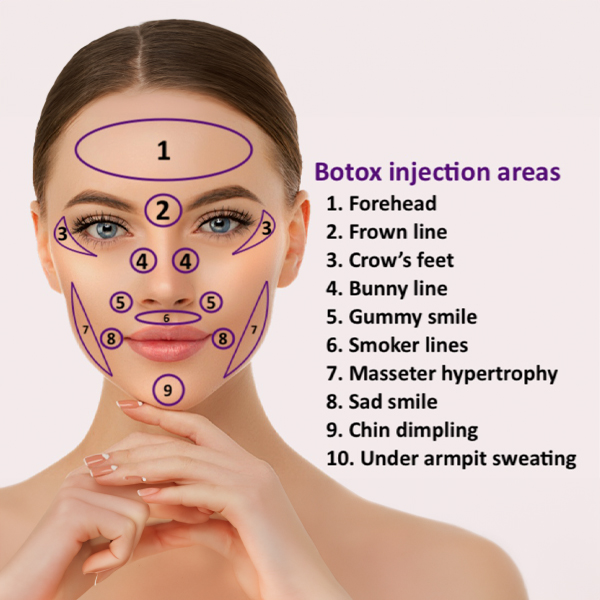 Botox injection areas